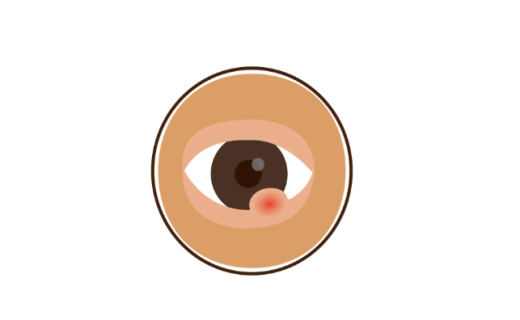 上海静安：大冷天火锅涮得太欢，眼睛偷偷“长痘”？医生：这不是巧合！